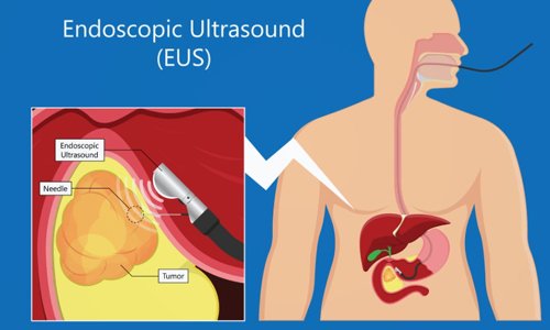 Endoscopic Ultrasound in Nagpur