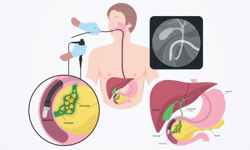 ERCP