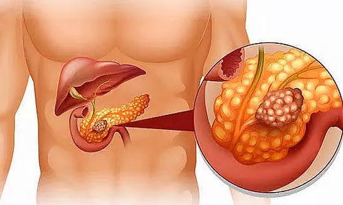 Pancreas Treatment in Nagpur
